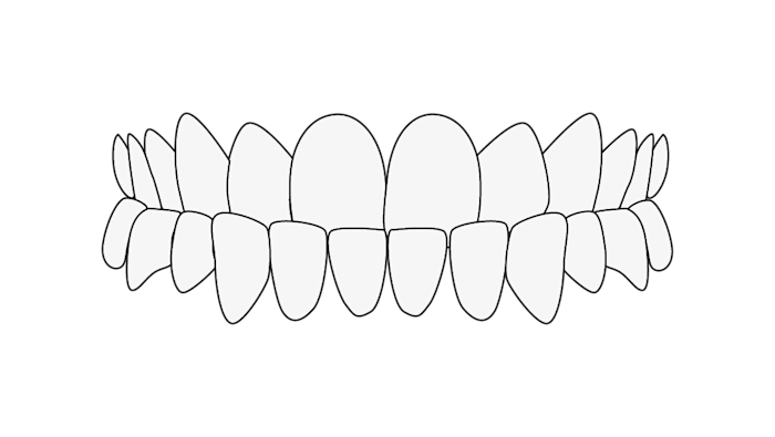 Misaligned Teeth: Head bite
