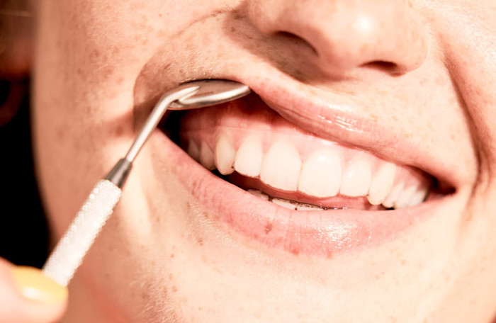 Des dents droites avec les aligneurs dentaires
