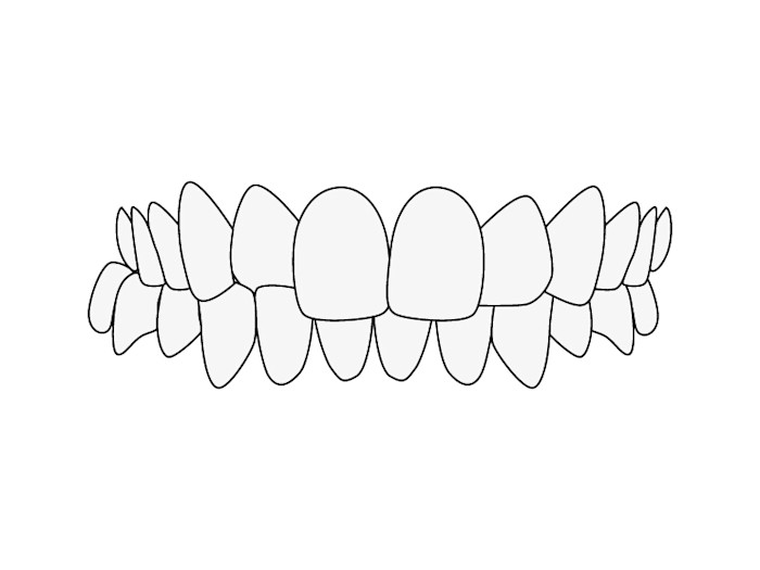 Malocclusion Crossbite