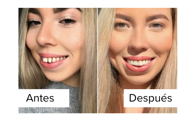 Alice-antes-despues