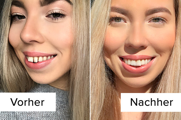Tiefbiss vorher nachher Zahnschiene