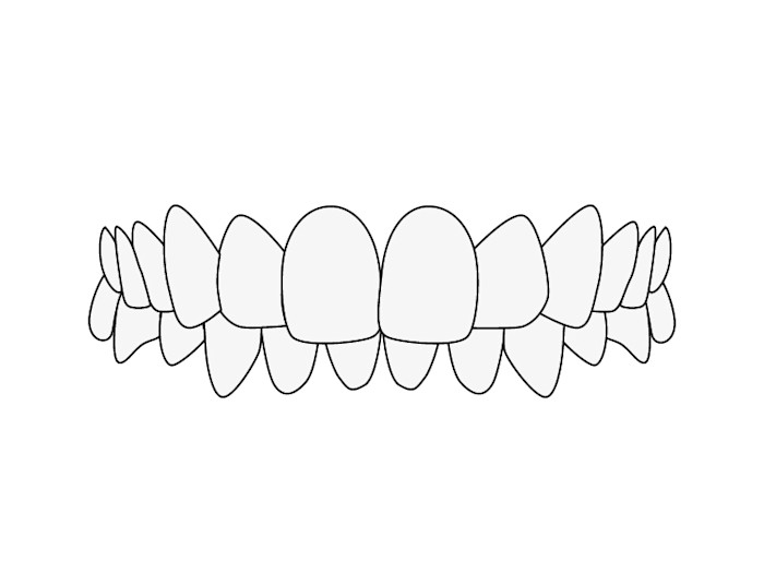 Misaligned Teeth: Deep bite