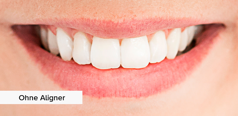 without-aligners UK
