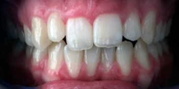 Morso profondo da disallineamento dentale