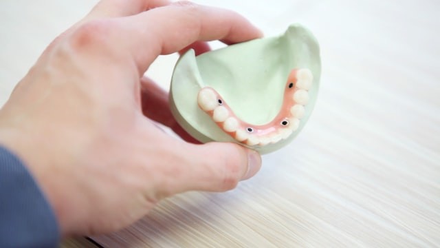 Bridges, crown and implants
