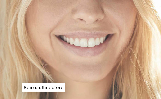 Senza-allineatore