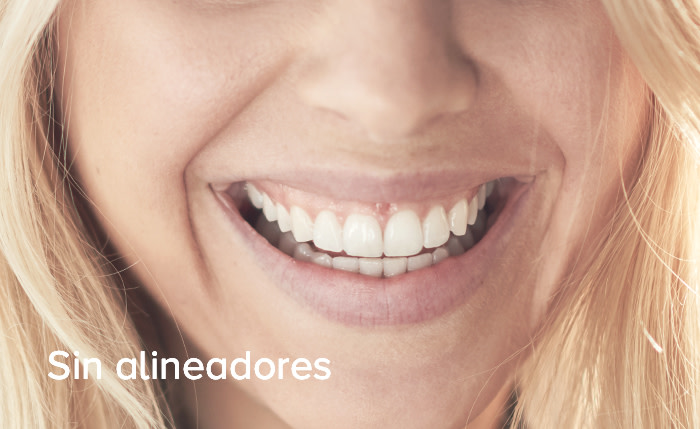 sin-alineadores