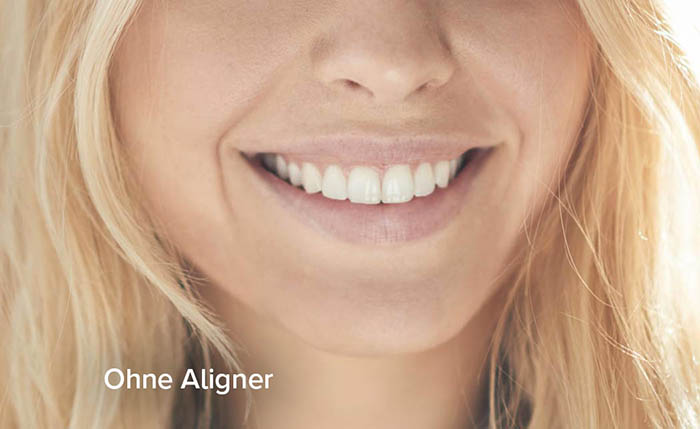 ohne-aligner