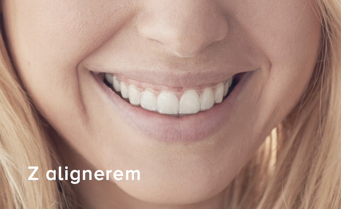 with Aligner - PL
