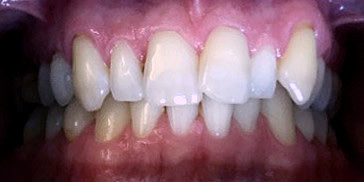 Crowding of the teeth - misaligned teeth