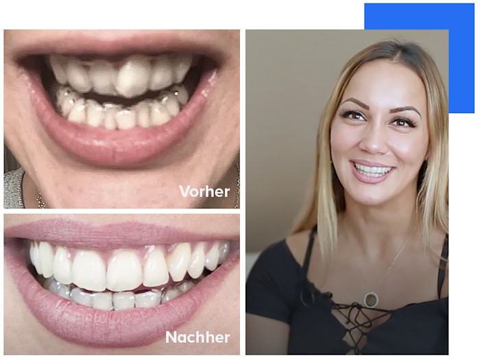 aylin beforeafter