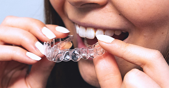 DrSmile Clear Aligner / Zahnschiene