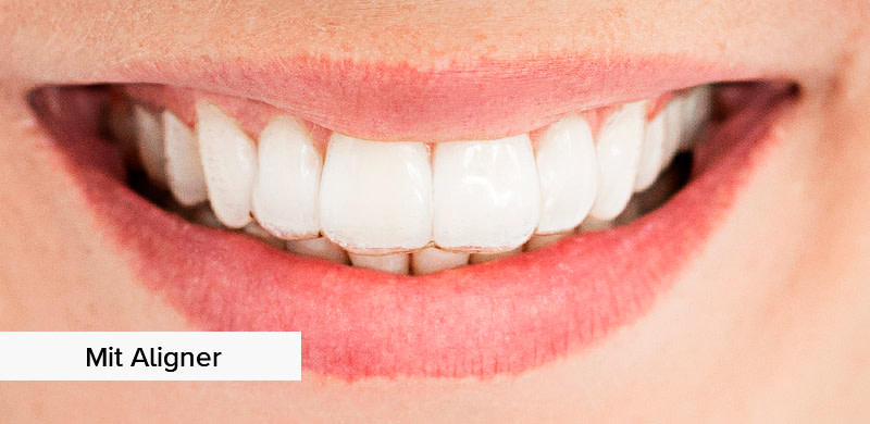 with-aligners UK