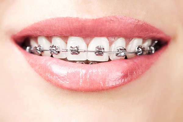 Aparato dental y brackets