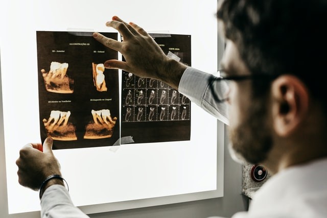 Bridges, crown and implants: differences, procedure and costs - Jonathan Barba