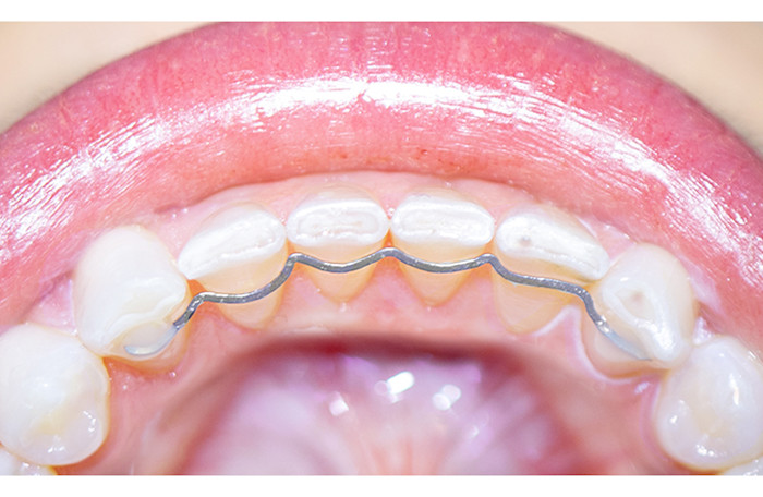 DrSmile permanent retainer