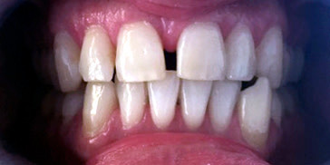 Malocclusion dentaire occlusion croisée y compris dents manquantes