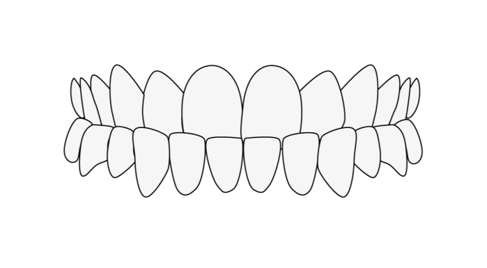 Misaligned Teeth: Head bite new