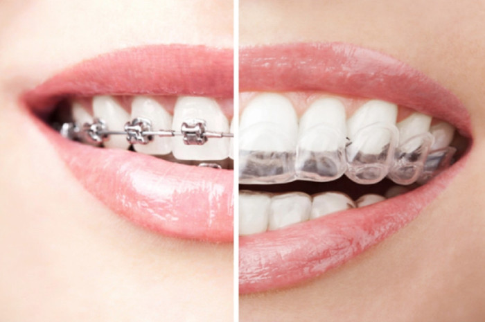 Allineatori o apparecchio ortodontico?