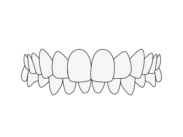 Disallineamento dei denti: Morso profondo