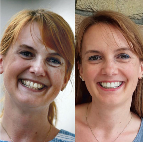Dr Smile Prima E Dopo DrSmile – Denti dritti con allineatori trasparenti