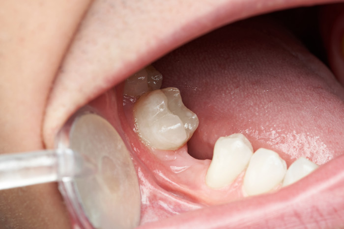 Zahnfehlstellung Hypodontie Zahnlücke Lücke fehlende Zähne Gap 2