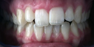 Teeth misalignment: deep bite