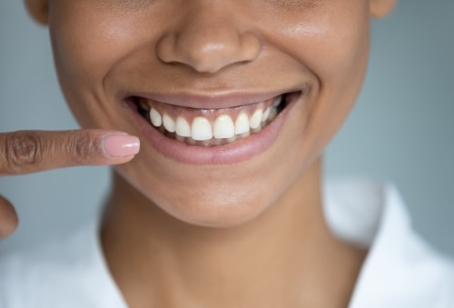 Gummy Smile - mit Zahnfleischkorrektur zum perfekten Lächeln