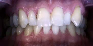 Apiñamiento dental: cuando los dientes tienen poco espacio