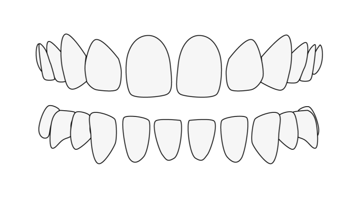 Zahnfehlstellung Zahnlücken