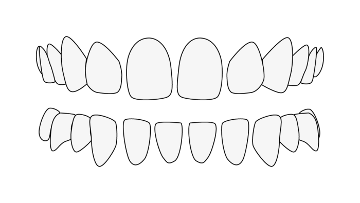 Separación de los dientes