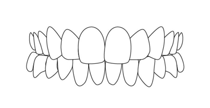Misaligned Teeth: Overbite