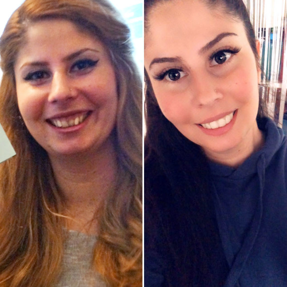 Dr Smile Prima E Dopo DrSmile – Denti dritti con allineatori trasparenti