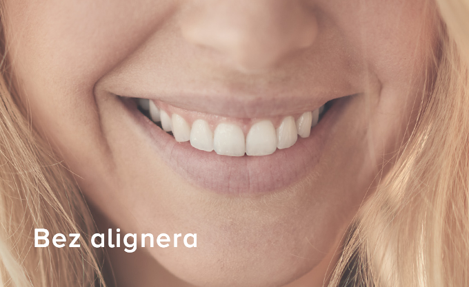without-aligners-pl