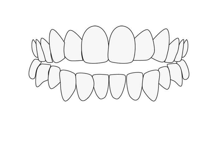 Misaligned Teeth: Open bite