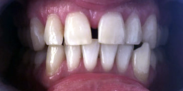 Zahnfehlstellung Kreuzbiss mit Zahnlücke